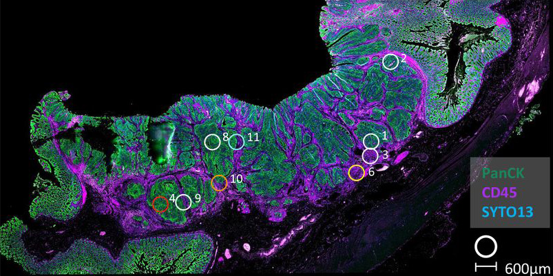 Whole slide image of colon cancer case selected for spatial transcriptomic analysis